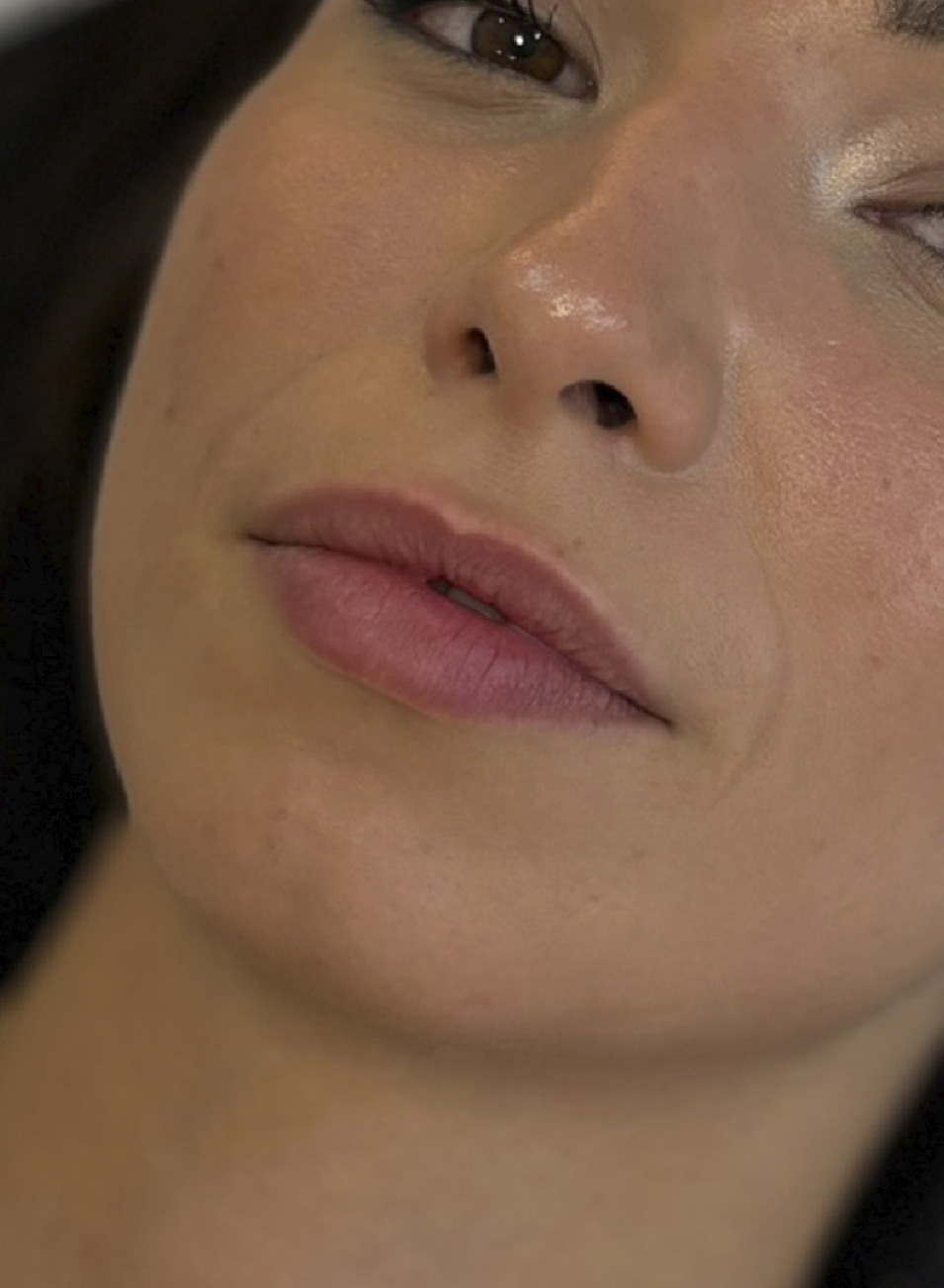 Foto Antes y después tratamiento ácido hialurónico para aumento y perfilado de labios