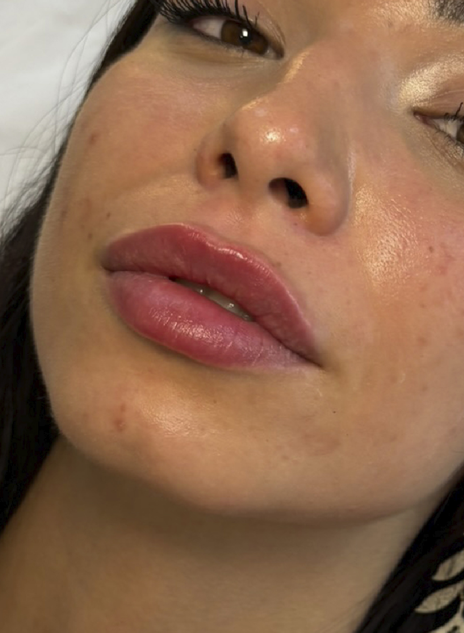 Foto Antes y después tratamiento ácido hialurónico para aumento y perfilado de labios