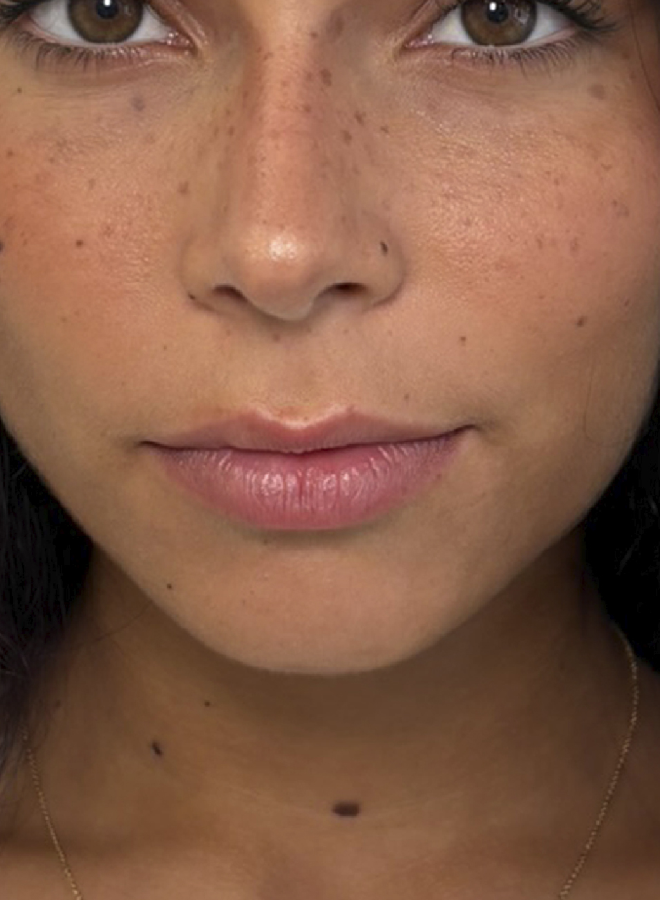 Foto Antes y después tratamiento ácido hialurónico para aumento y perfilado de labios
