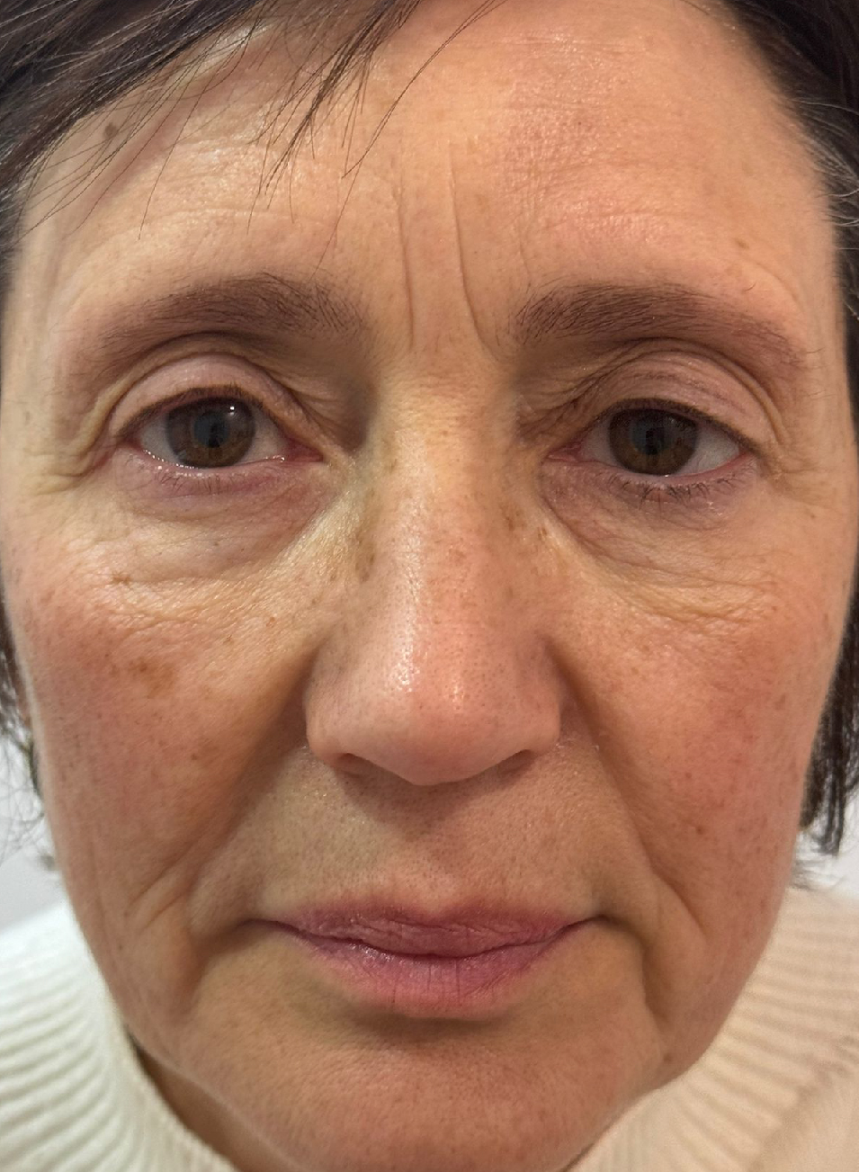 Foto Antes y después tratamiento Micropigmentación de cejas - Microblading