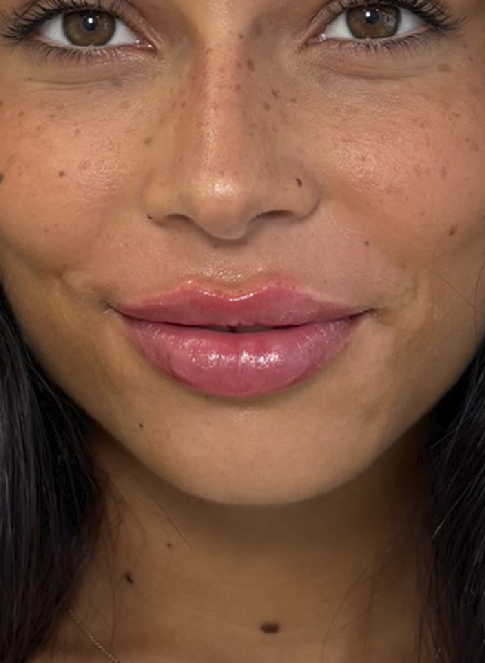 Foto Antes y después tratamiento ácido hialurónico para aumento y perfilado de labios