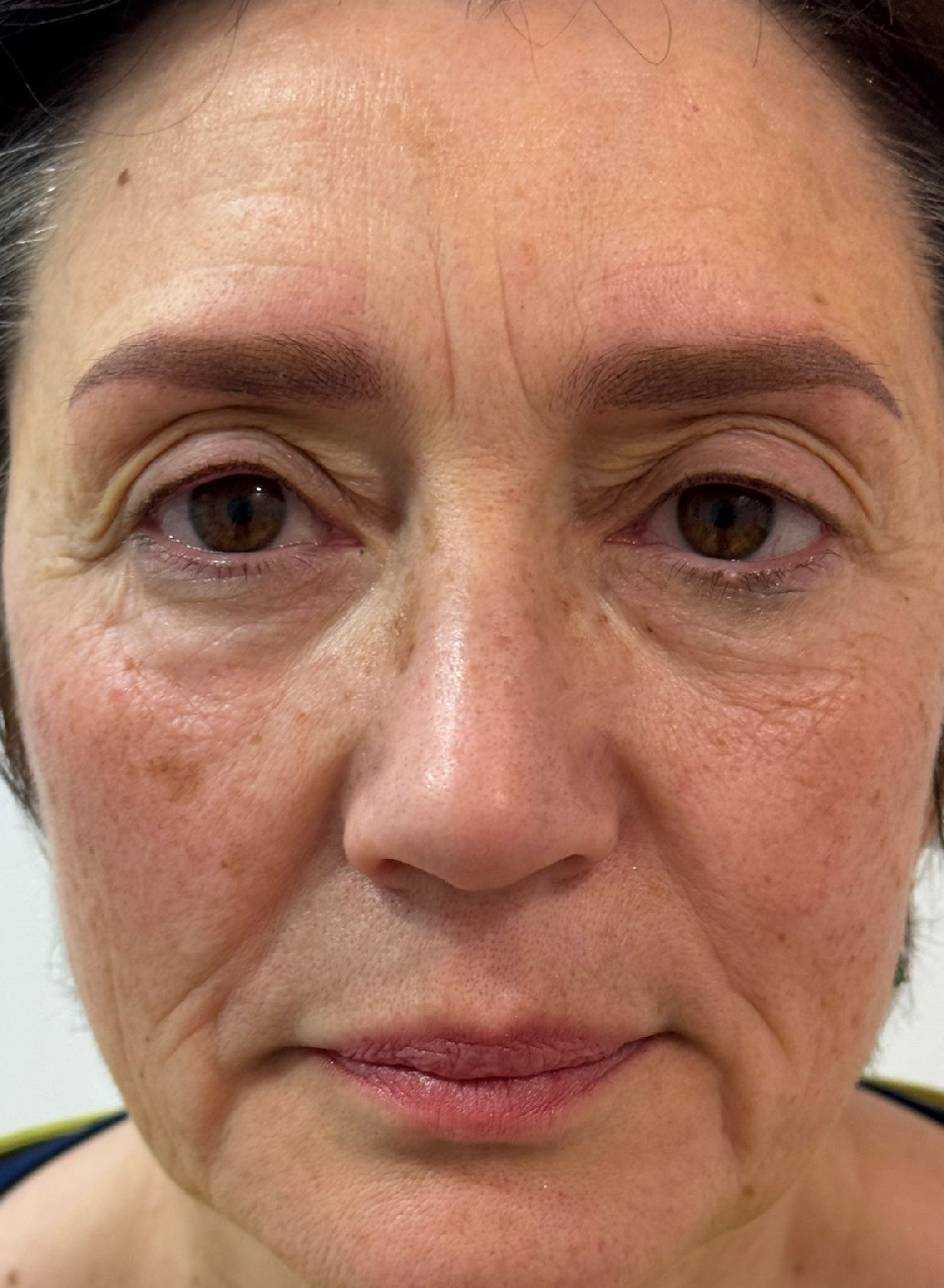 Foto Antes y después tratamiento Micropigmentación de cejas - Microblading