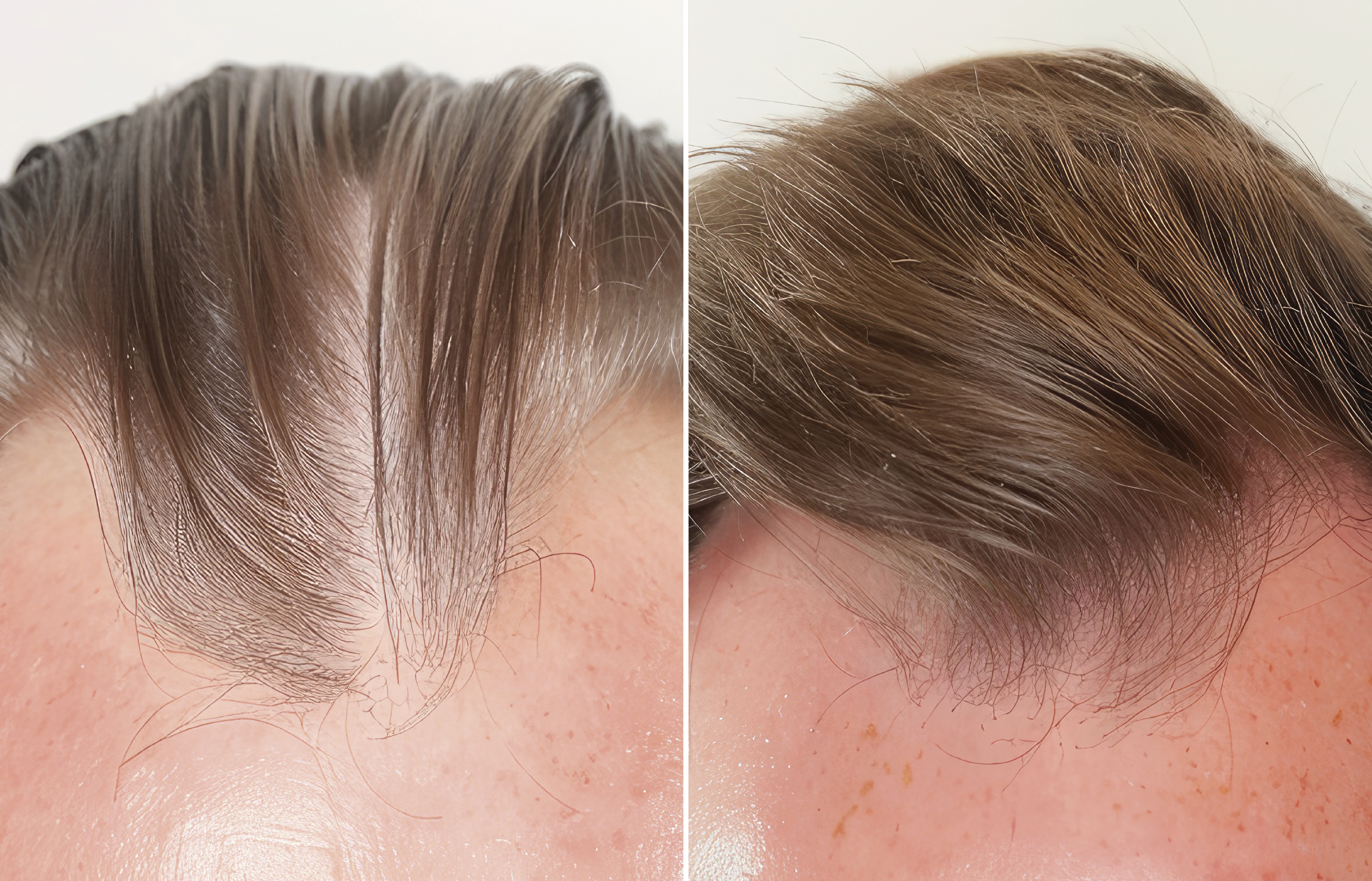 Foto Antes y después tratamiento Mesoterapia Capilar + Plasma Rico en Plaquetas