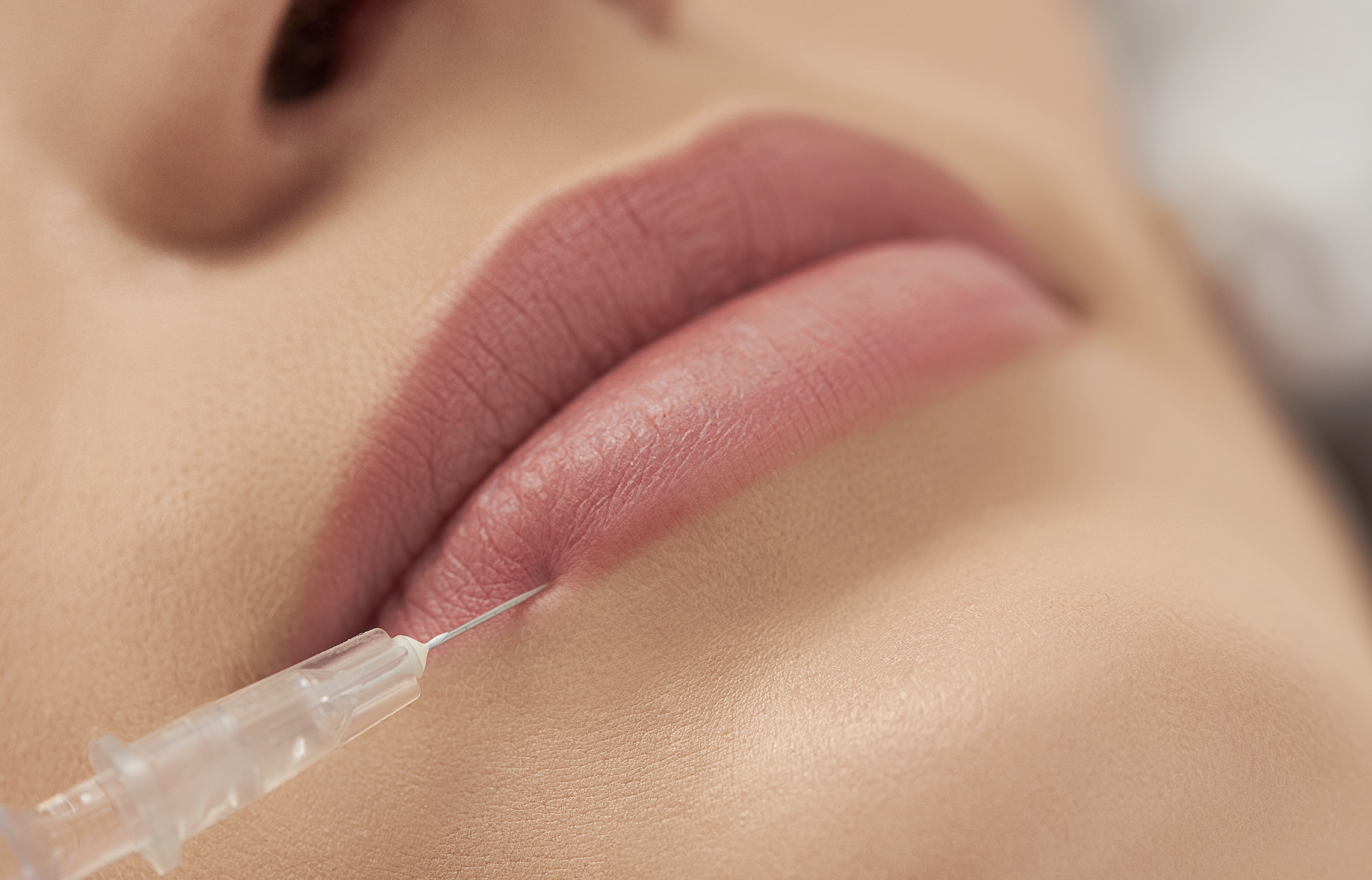 Foto tratamiento Tratamiento ácido hialurónico para aumento y perfilado de labios
