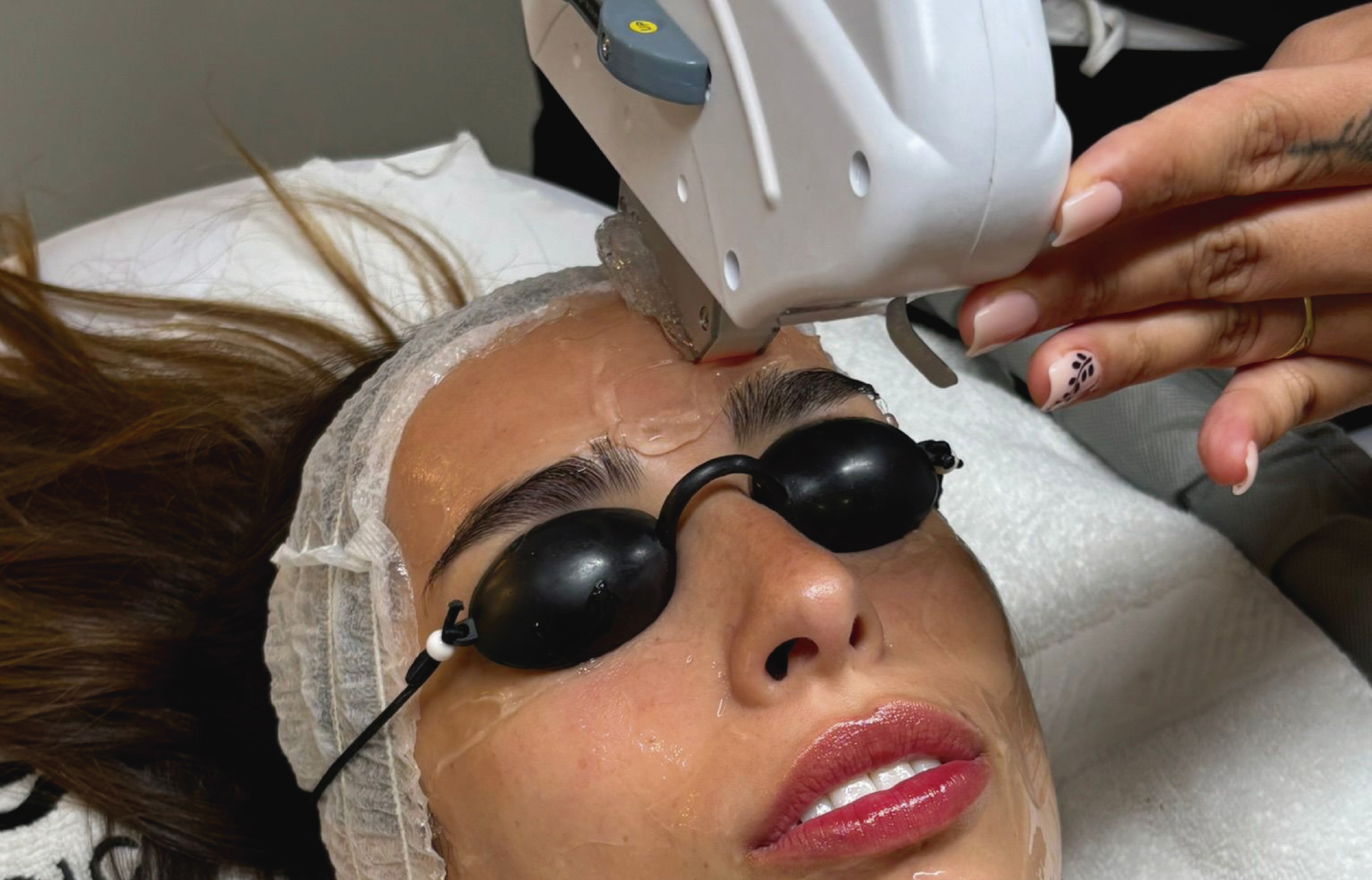 Foto tratamiento Bioestimuladores de colágeno - Facial, corporal y glúteos