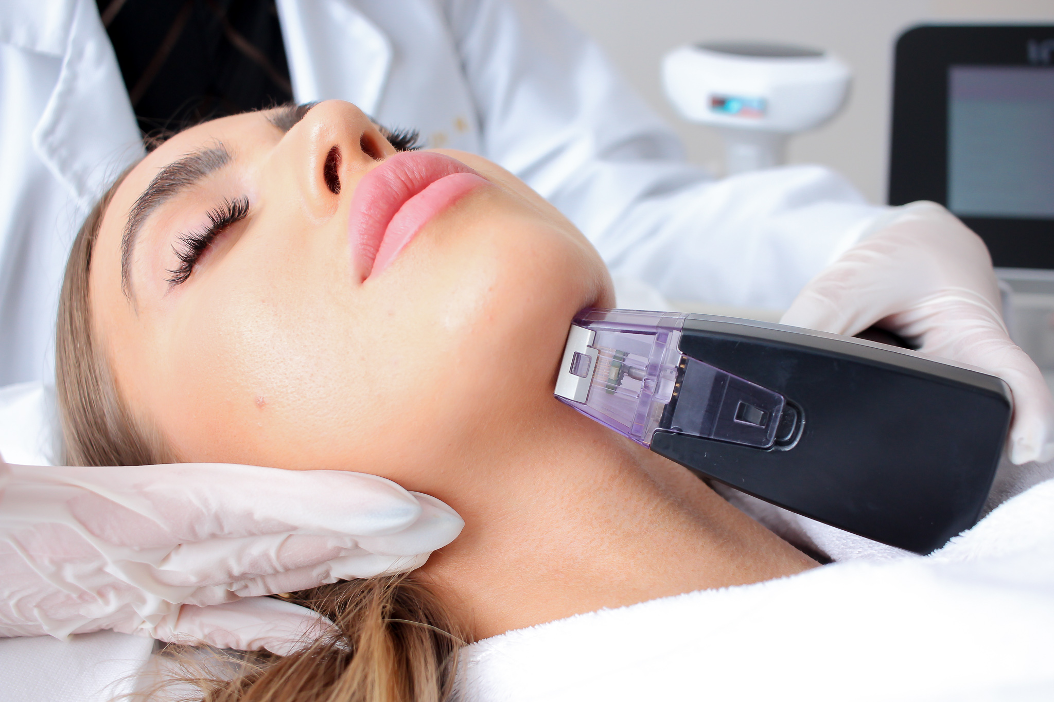Foto Antes y después tratamiento Radiofrecuencia fraccionada - Lifting facial sin cirugía