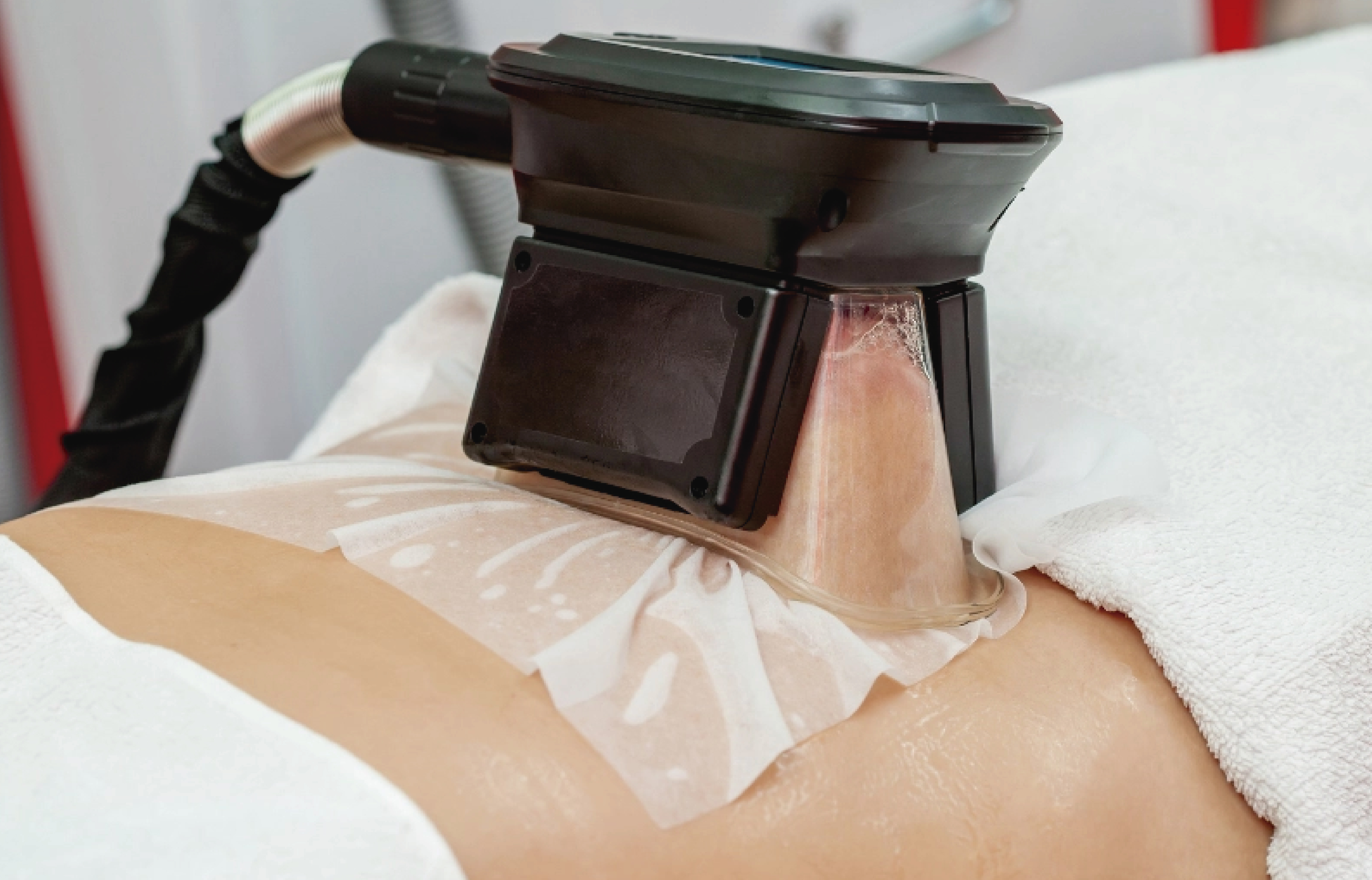 Foto tratamiento HIFU Ultraformer - Lifting facial sin cirugía