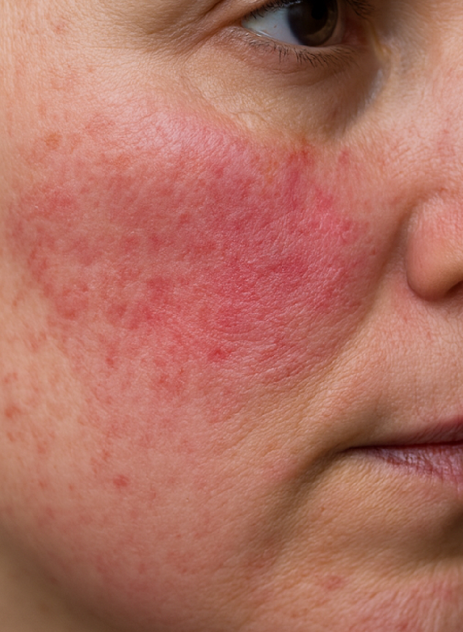 Foto Antes y después Tratamiento para la Rosácea con Mesobotox - Toxina Botulínica + Mesoterapia​