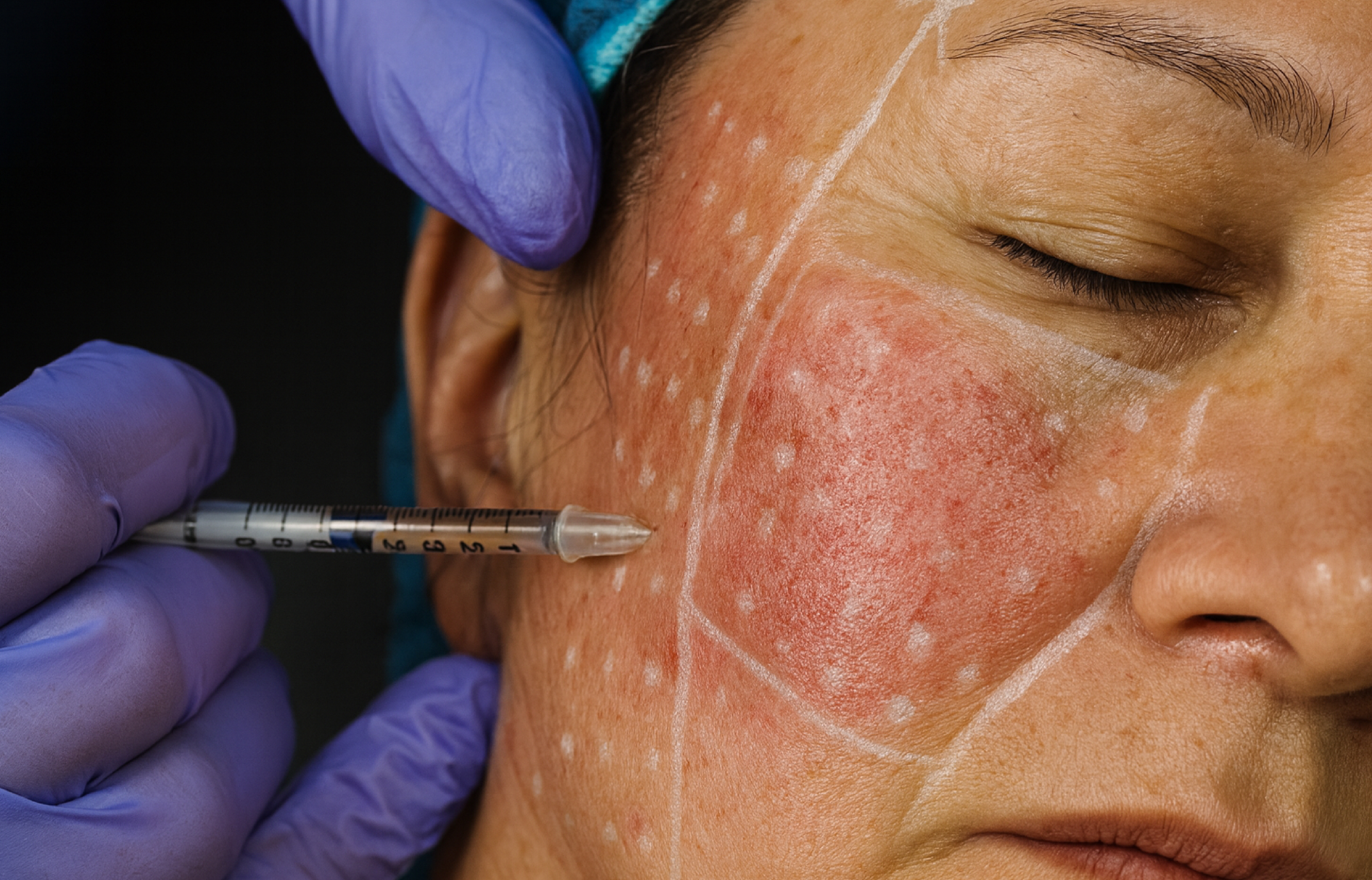 Foto Antes y después Tratamiento para la Rosácea con Mesobotox - Toxina Botulínica + Mesoterapia​