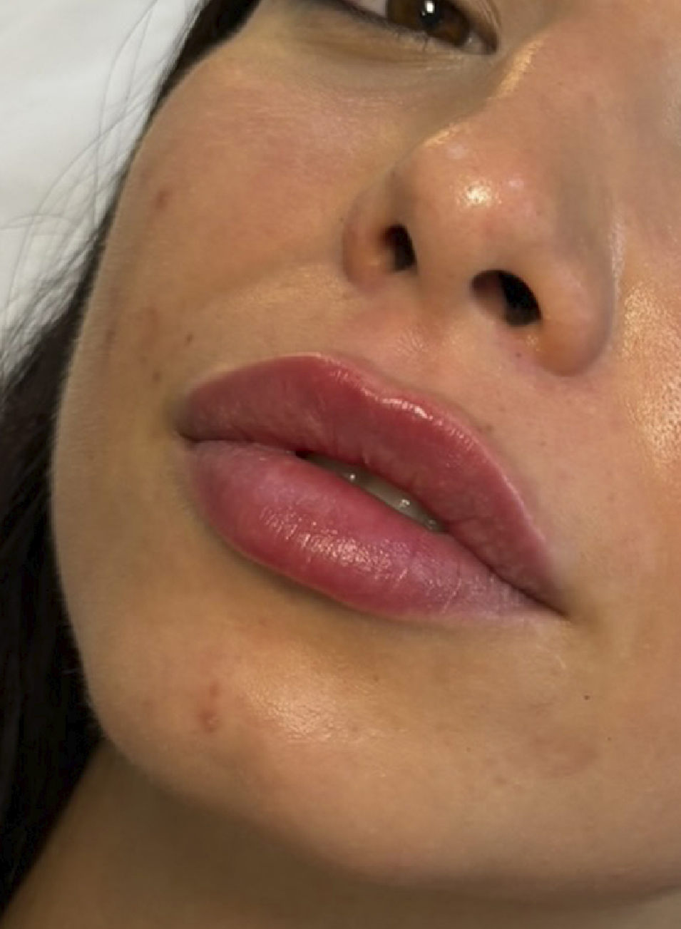 Foto Antes y después tratamiento relleno de labios