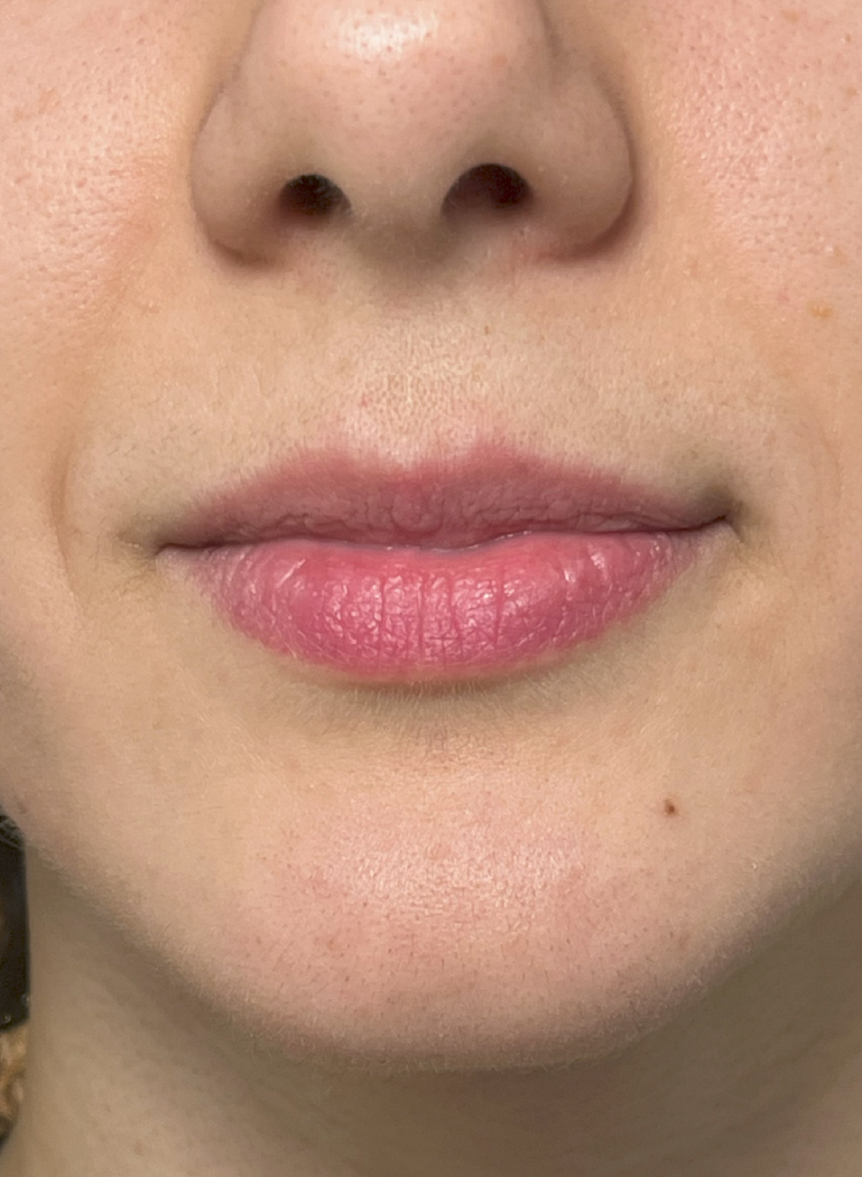 Foto Antes y después tratamiento relleno de labios