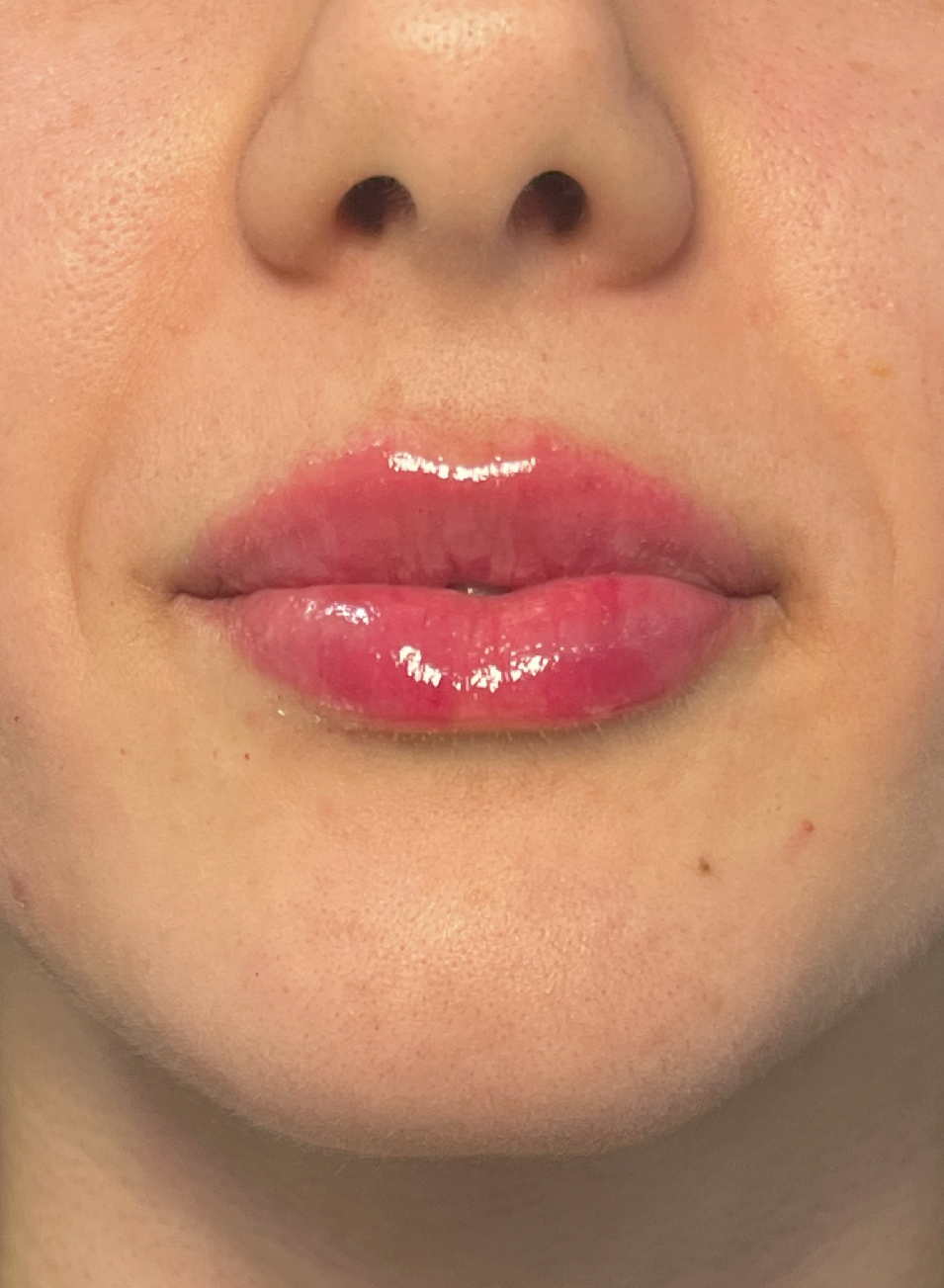 Foto Antes y después tratamiento relleno de labios