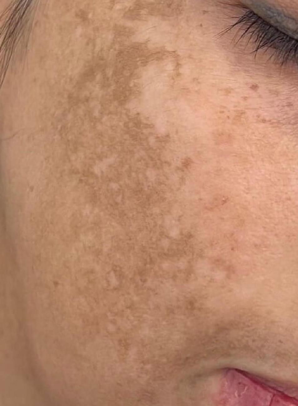 Foto Antes y después tratamiento Fotorejuvenecimiento facial en Barcelona