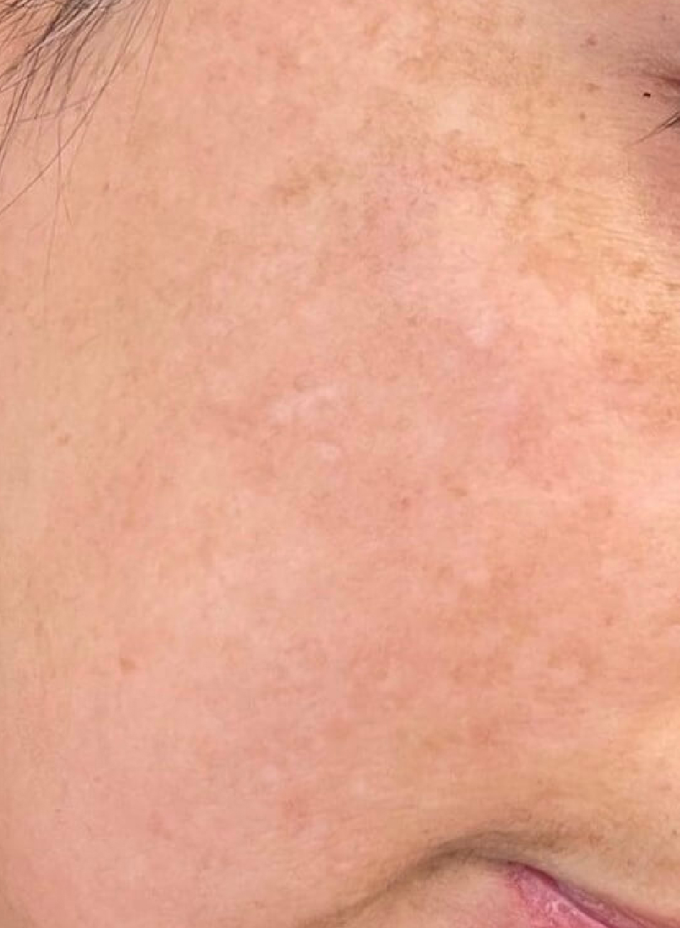 Foto Antes y después tratamiento Fotorejuvenecimiento facial en Barcelona