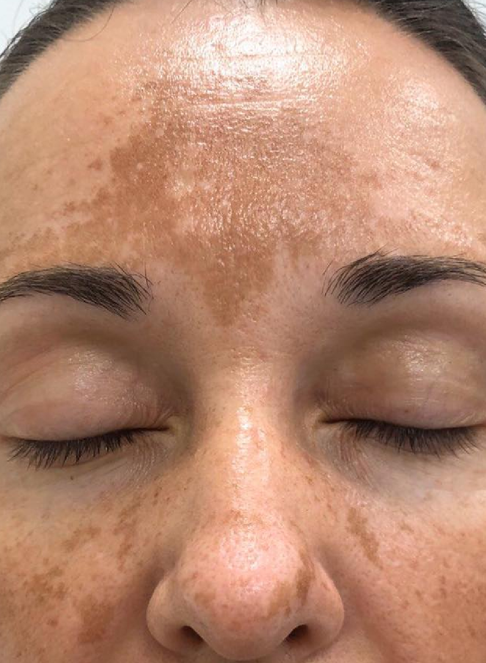 Foto Antes y después tratamiento Fotorejuvenecimiento facial en Barcelona