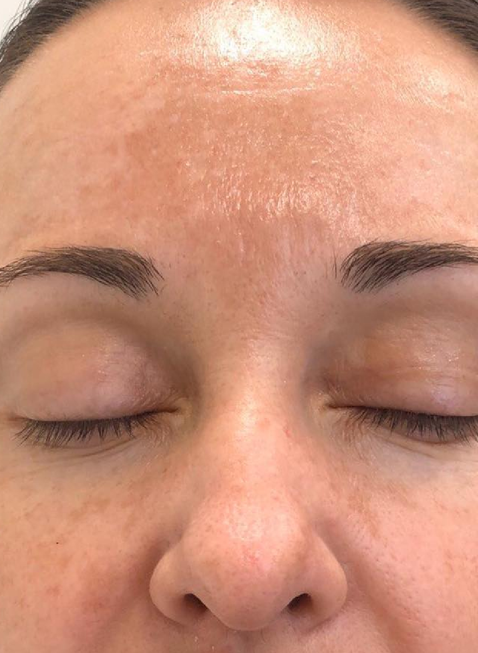 Foto Antes y después tratamiento Fotorejuvenecimiento facial en Barcelona