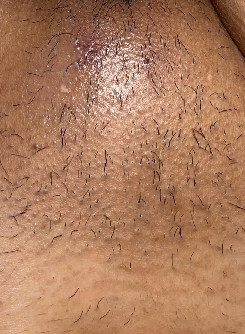 Foto Antes y después tratamiento ingle brasileña