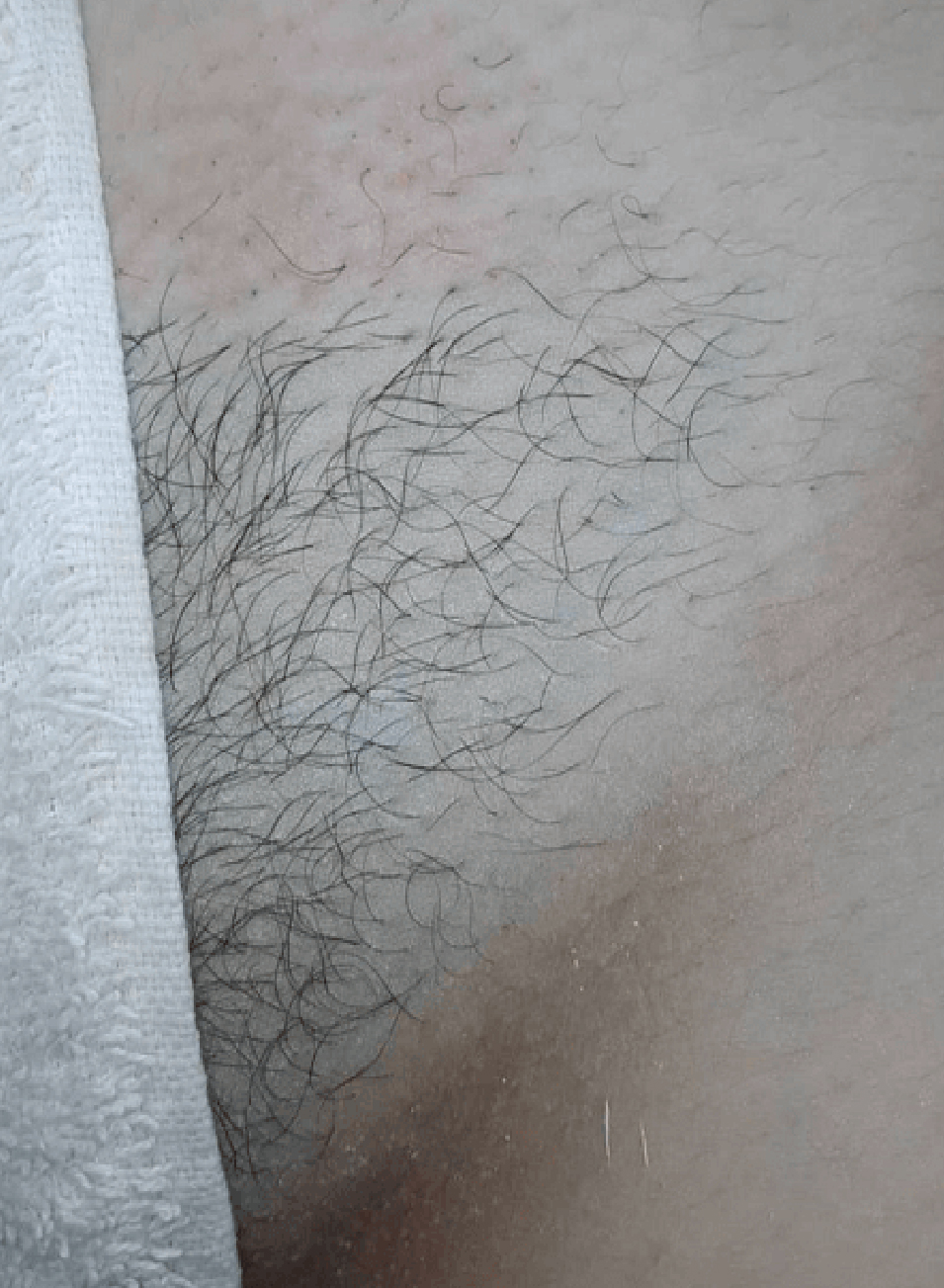 Foto Antes y después tratamiento ingle brasileña