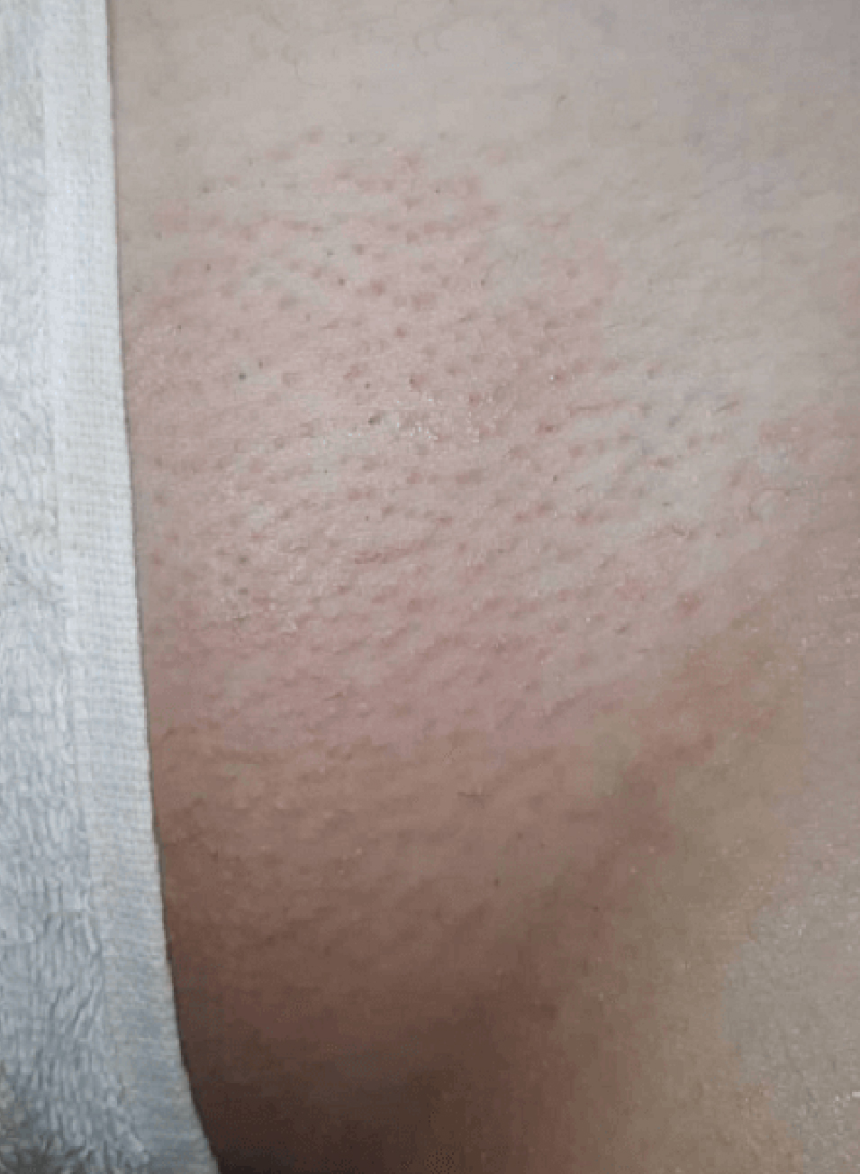 Foto Antes y después tratamiento ingle brasileña