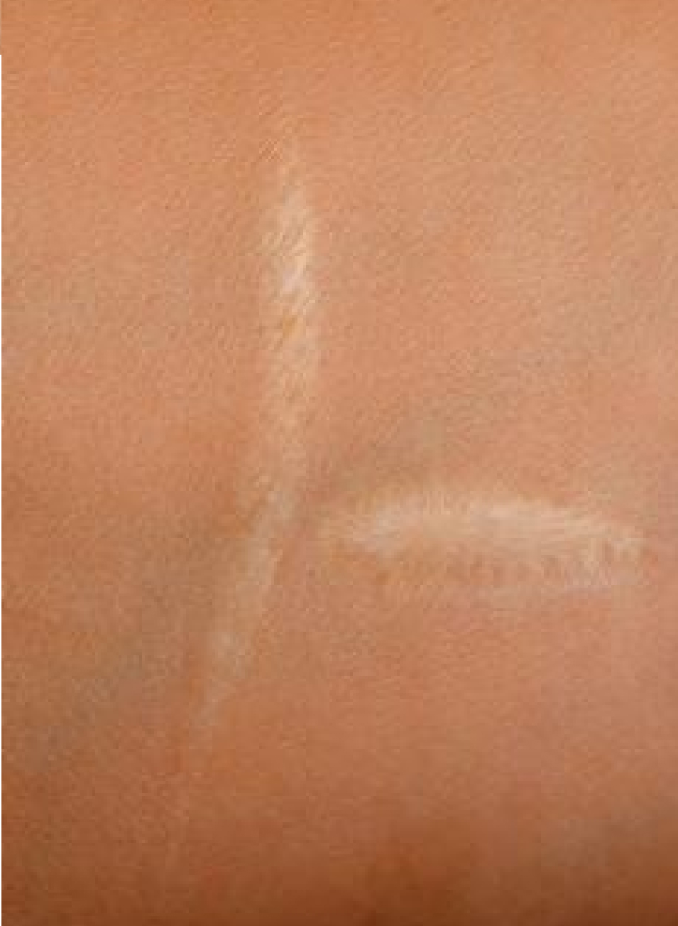 Foto Antes y después tratamiento Camuflaje de cicatrices con micropigmentacion