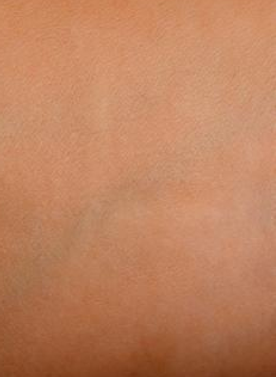 Foto Antes y después tratamiento Camuflaje de cicatrices con micropigmentacion