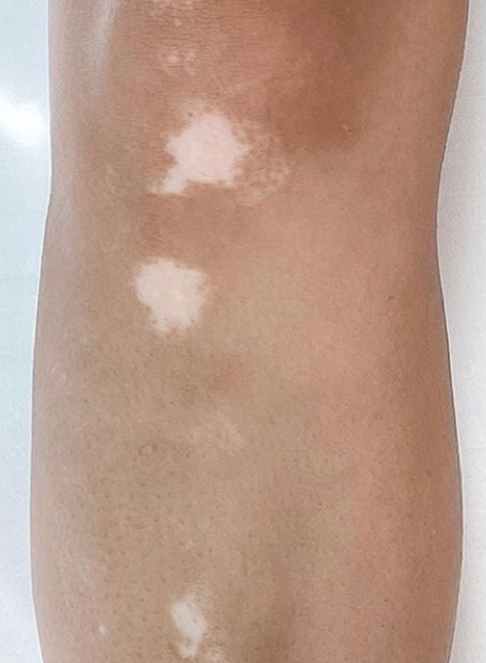 Foto Antes y después tratamiento Camuflaje de cicatrices con micropigmentacion