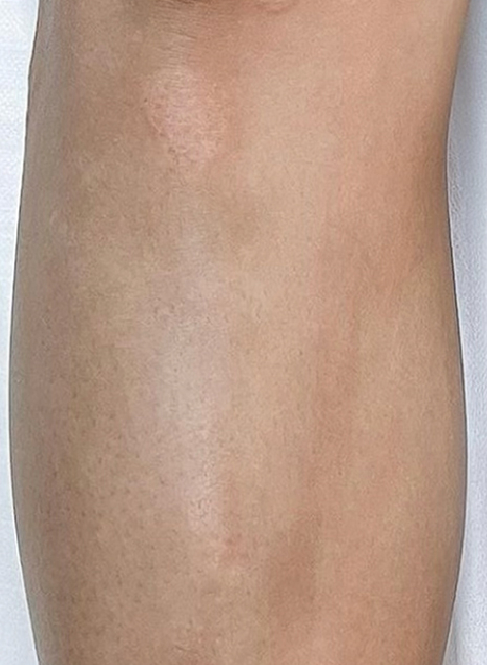 Foto Antes y después tratamiento Camuflaje de cicatrices con micropigmentacion