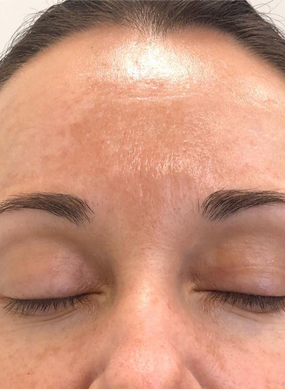 Resultados Tratamiento Láser CO₂ Fraccionado en Barcelona – Rejuvenecimiento Facial Avanzado