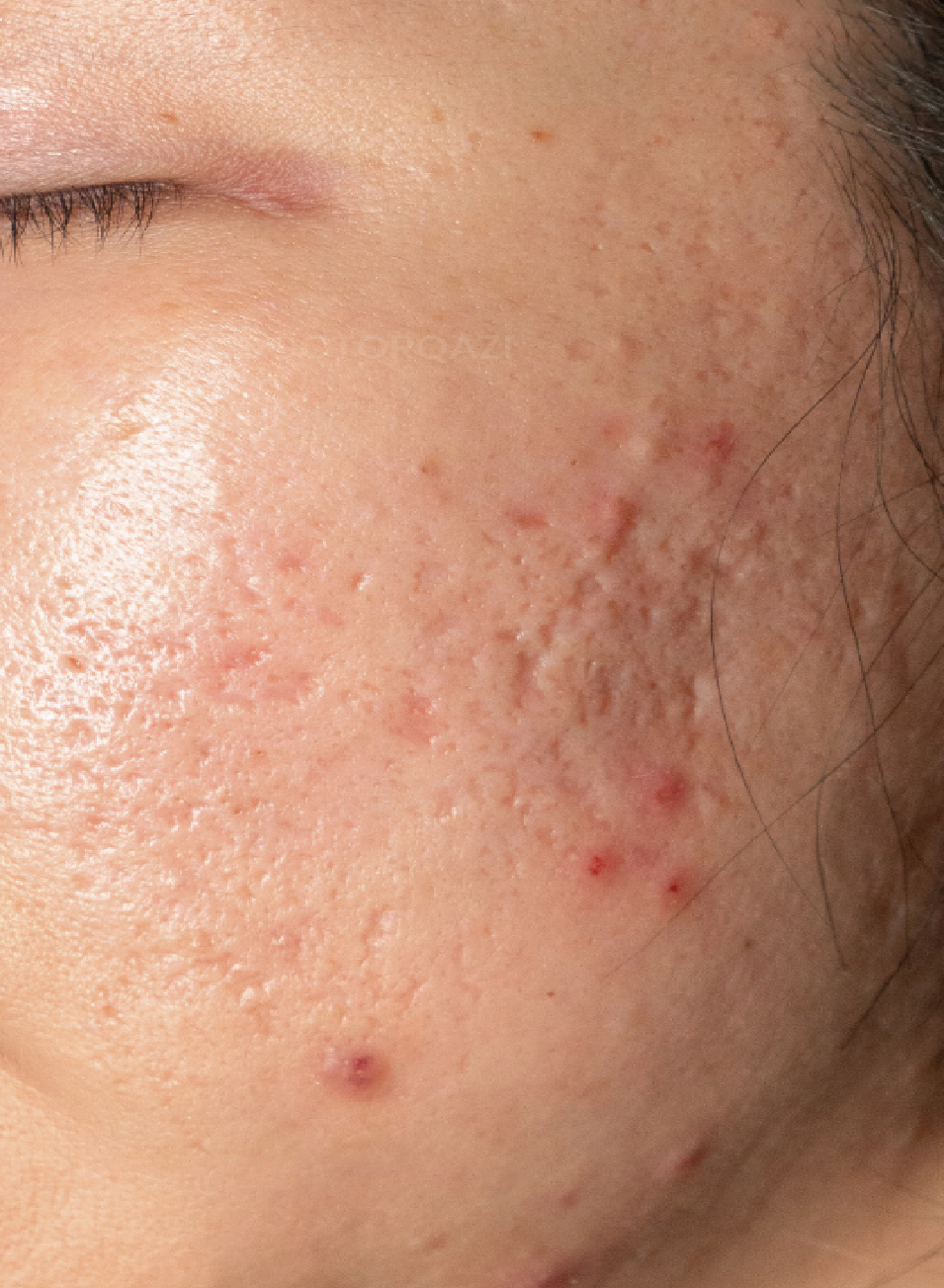 Resultados Tratamiento Láser CO₂ Fraccionado en Barcelona – Rejuvenecimiento Facial Avanzado