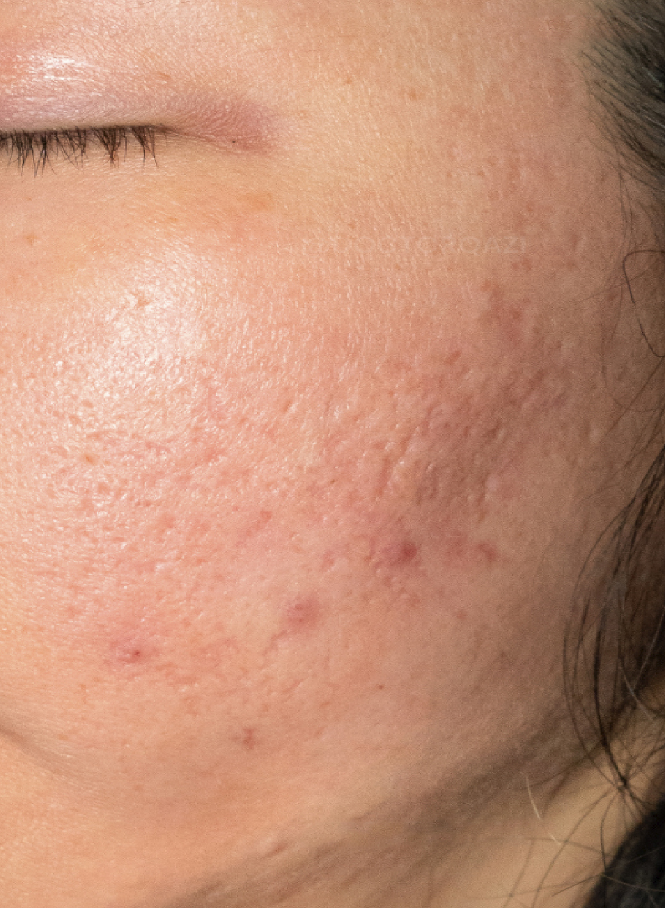 Resultados Tratamiento Láser CO₂ Fraccionado en Barcelona – Rejuvenecimiento Facial Avanzado