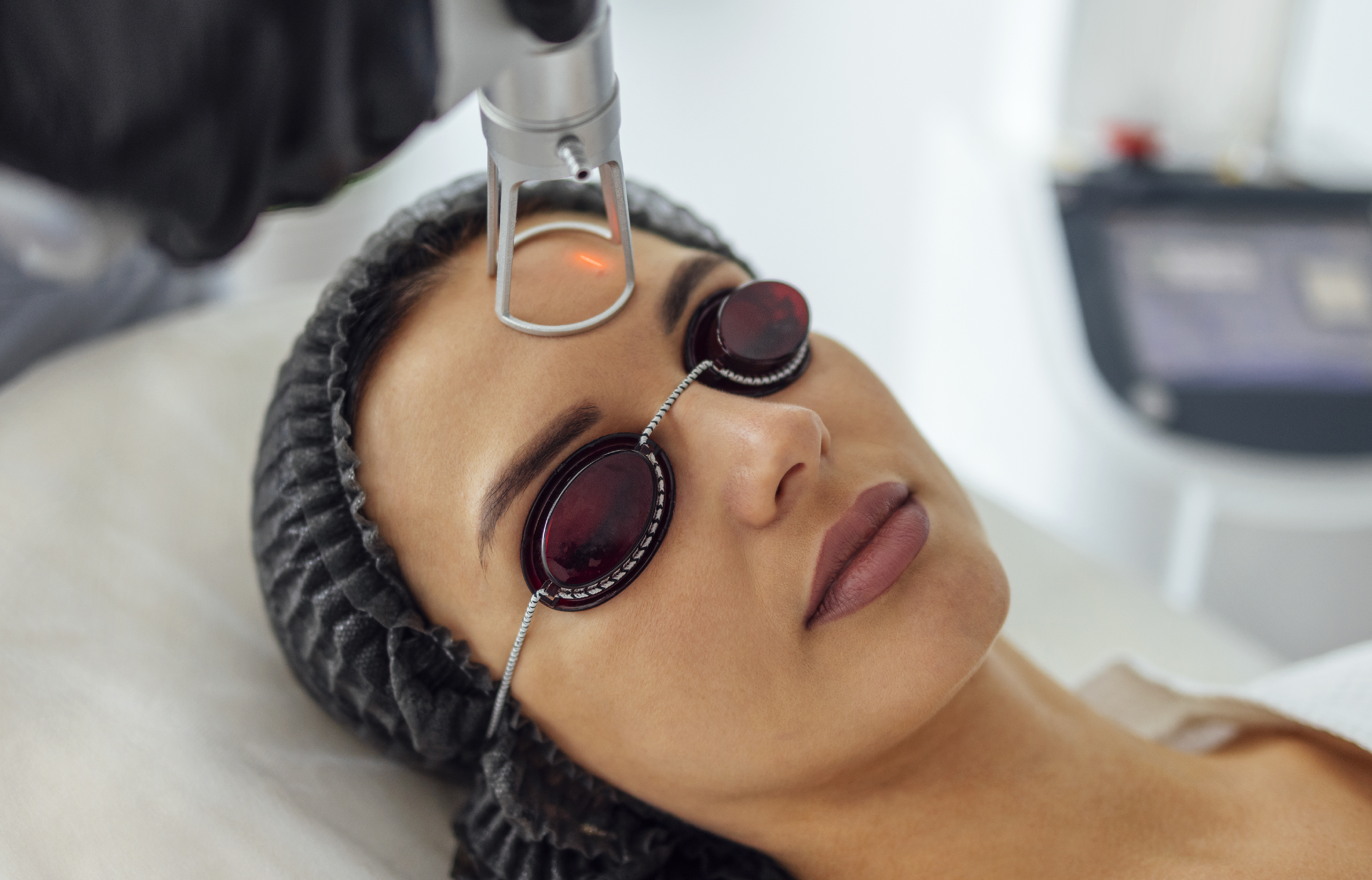 Resultados Tratamiento Láser CO₂ Fraccionado en Barcelona – Rejuvenecimiento Facial Avanzado